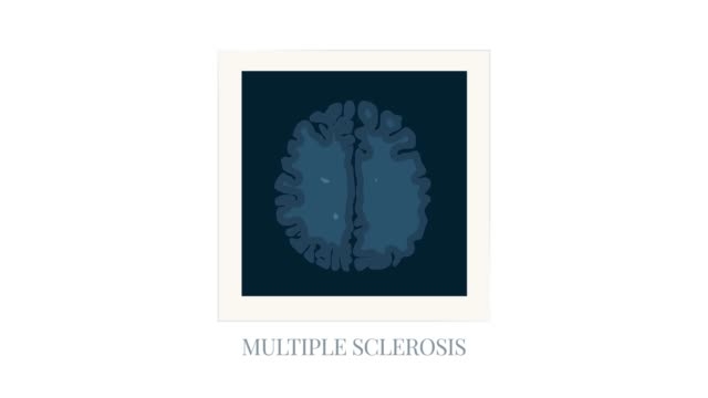 MRI in MS